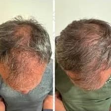 Vitti Pure Hair Restoration Package at Cedar & Sage Aesthetics & Wellness in Hiawassee, GA