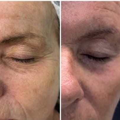 Vitti-Pure Under-Eye Rejuvenation at Cedar & Sage Aesthetics & Wellness in Hiawassee, GA